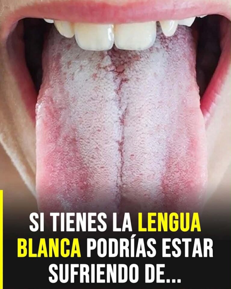 Lengua Blanca: La Señal En Tu Boca Que Podría Estar Alertando Sobre Tu Salud