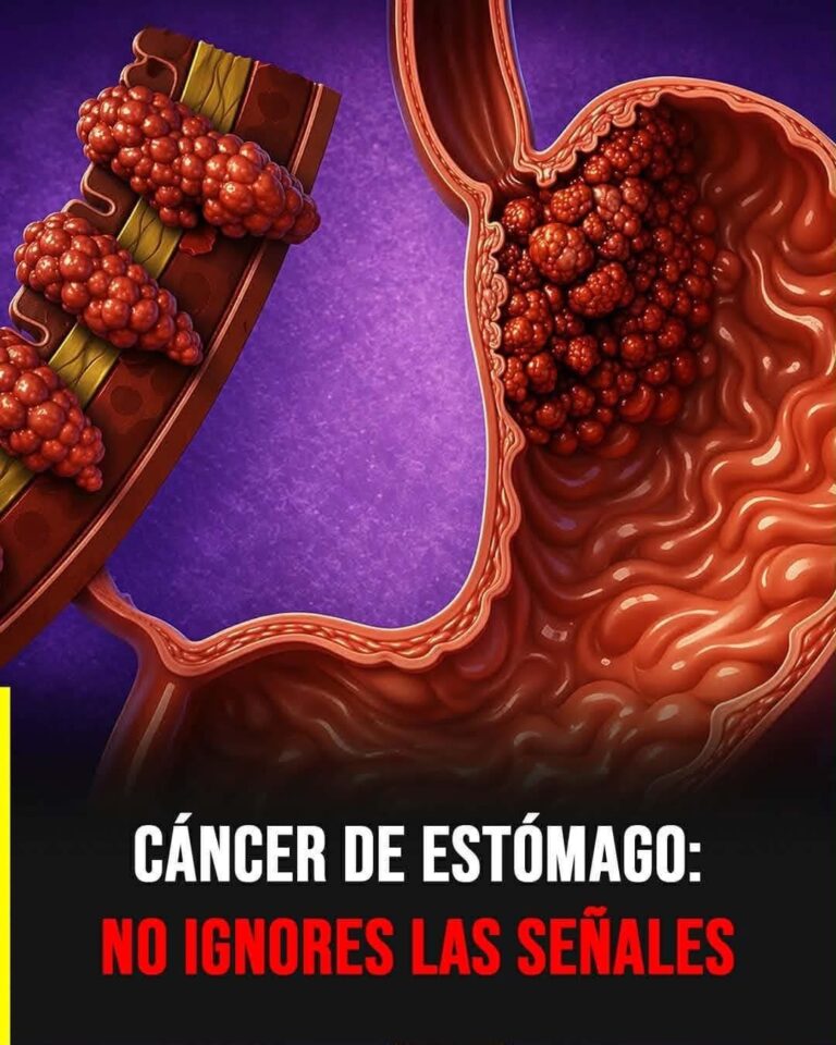 ⚠️ Cáncer de estómago: señales silenciosas que muchas personas confunden con algo común