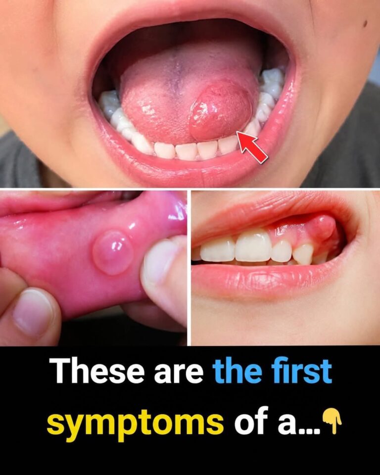 🚨 Dentistas alertan sobre estas pequeñas bolas en la boca que muchos ignoran