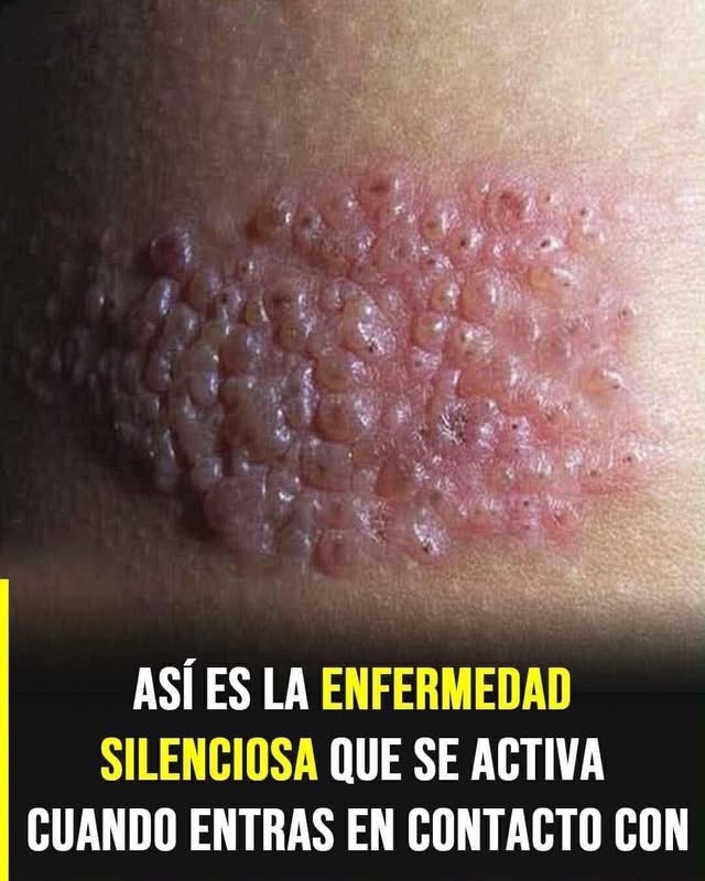 ⚠️ Así es el herpes zóster: la enfermedad silenciosa que puede aparecer cuando menos lo esperas