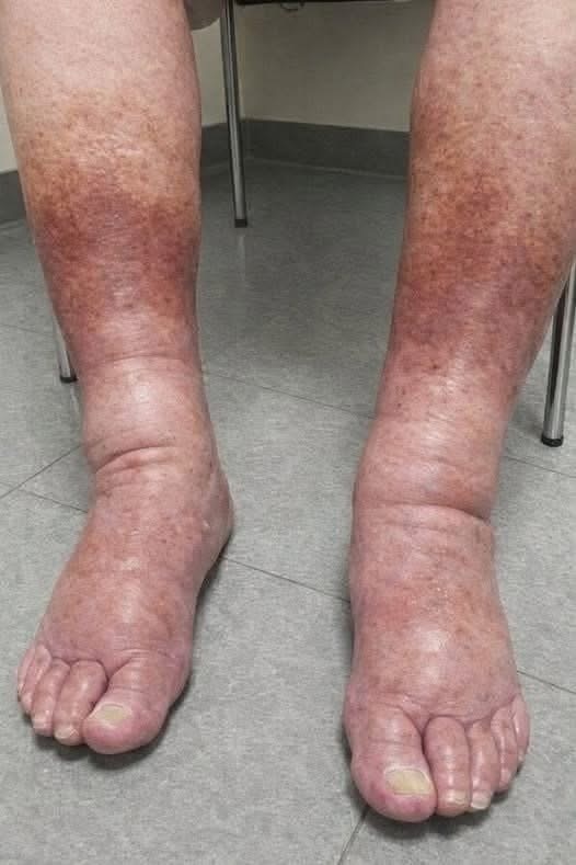 Lo que parecen pies hinchados normales podría estar enviando una señal importante de tu salud