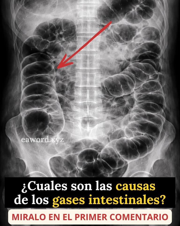 Gases intestinales: causas, alimentos que los provocan y señales de alerta